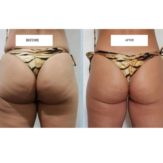 CelluLift™ | Firm your skin with the anti-cellulite vacuum massager
