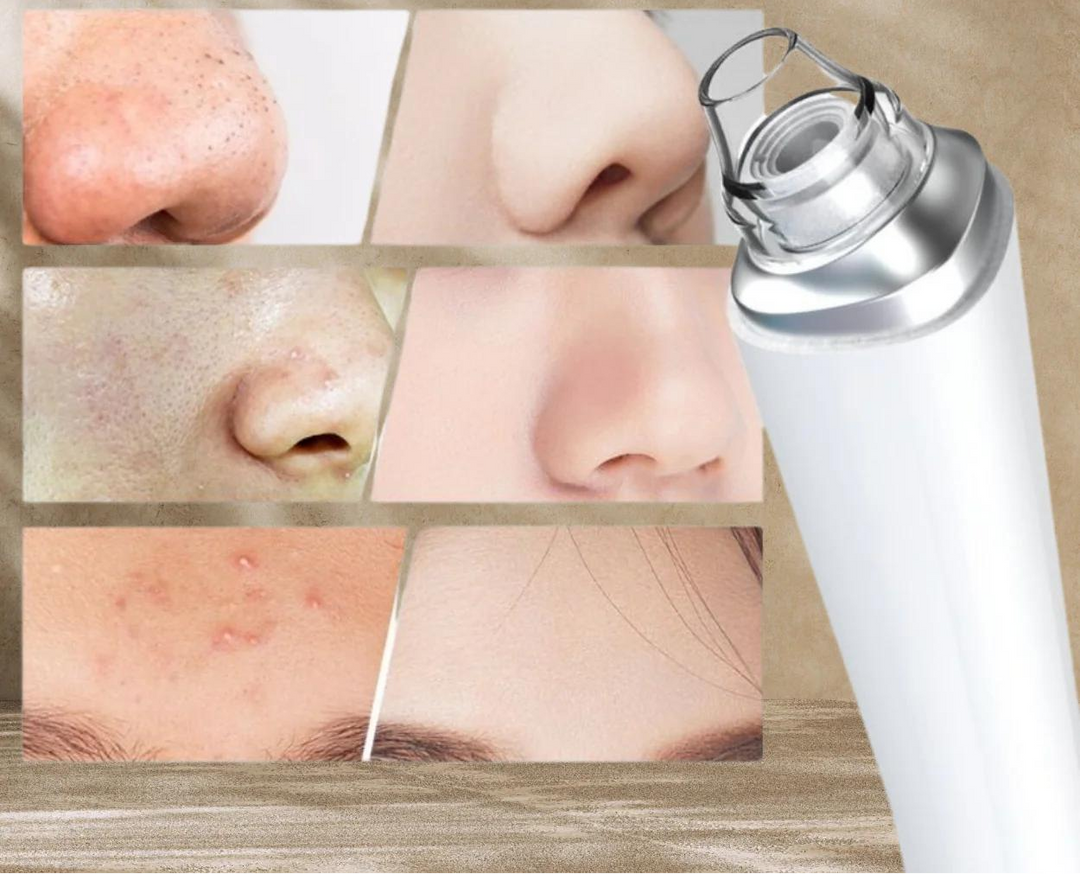 PureSight™ | Remove blackheads with precision