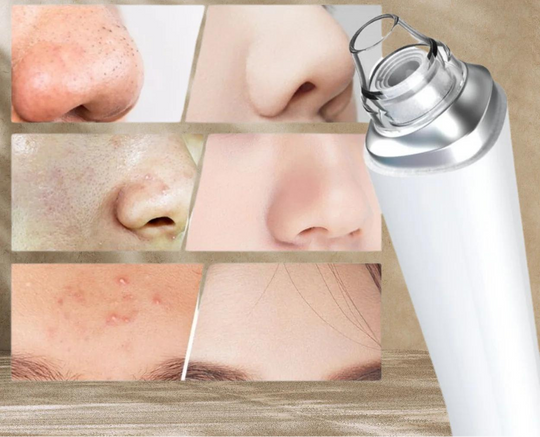 PureSight™ | Remove blackheads with precision