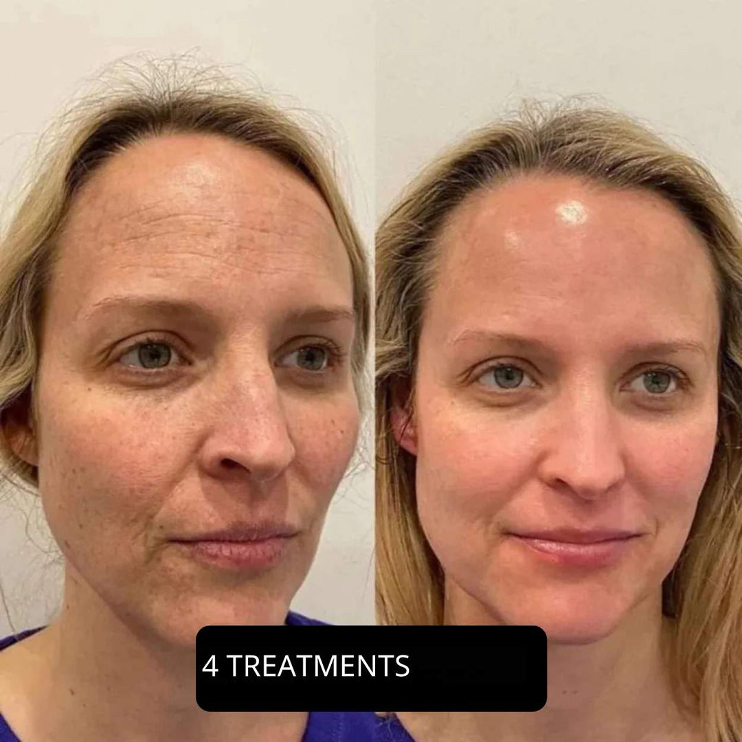 PureSight™ | Remove blackheads with precision