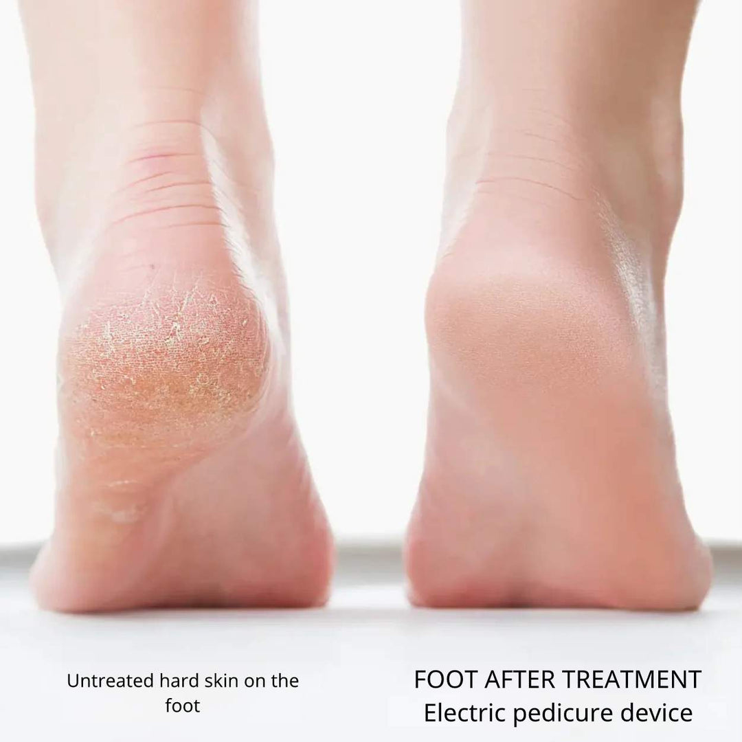 Electric Pedicure Device™ | Instantly smooth skin!