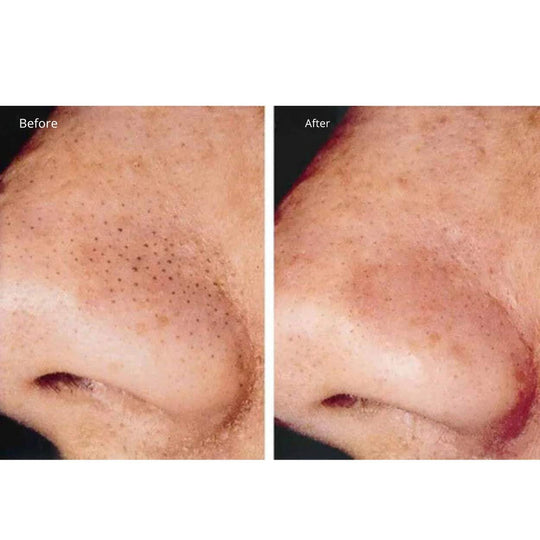 PureSight™ | Remove blackheads with precision