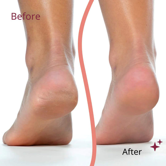 Electric Pedicure Device™ | Instantly smooth skin!