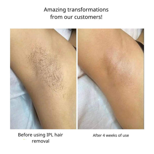 IPL Hair Removal™ | Say goodbye to unwanted hair