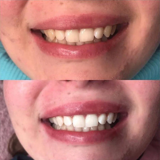 SmileKit™ | White teeth, healthy gums, and fresh breath