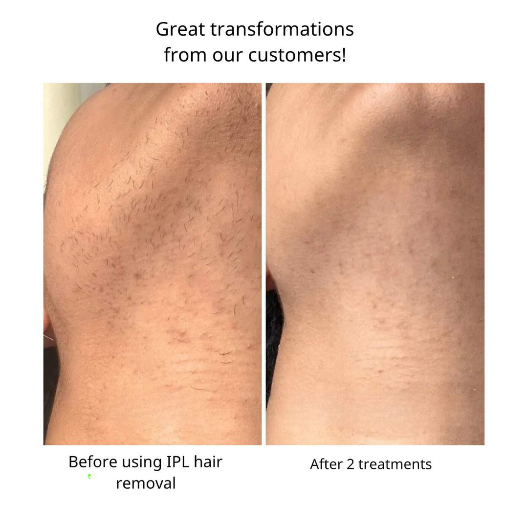 IPL Hair Removal™ | Say goodbye to unwanted hair