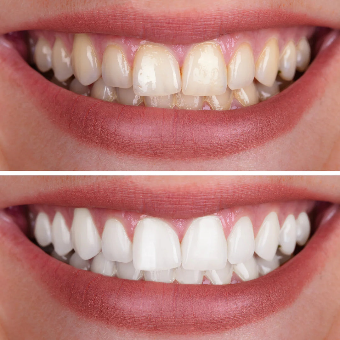SmileKit™ | White teeth, healthy gums, and fresh breath