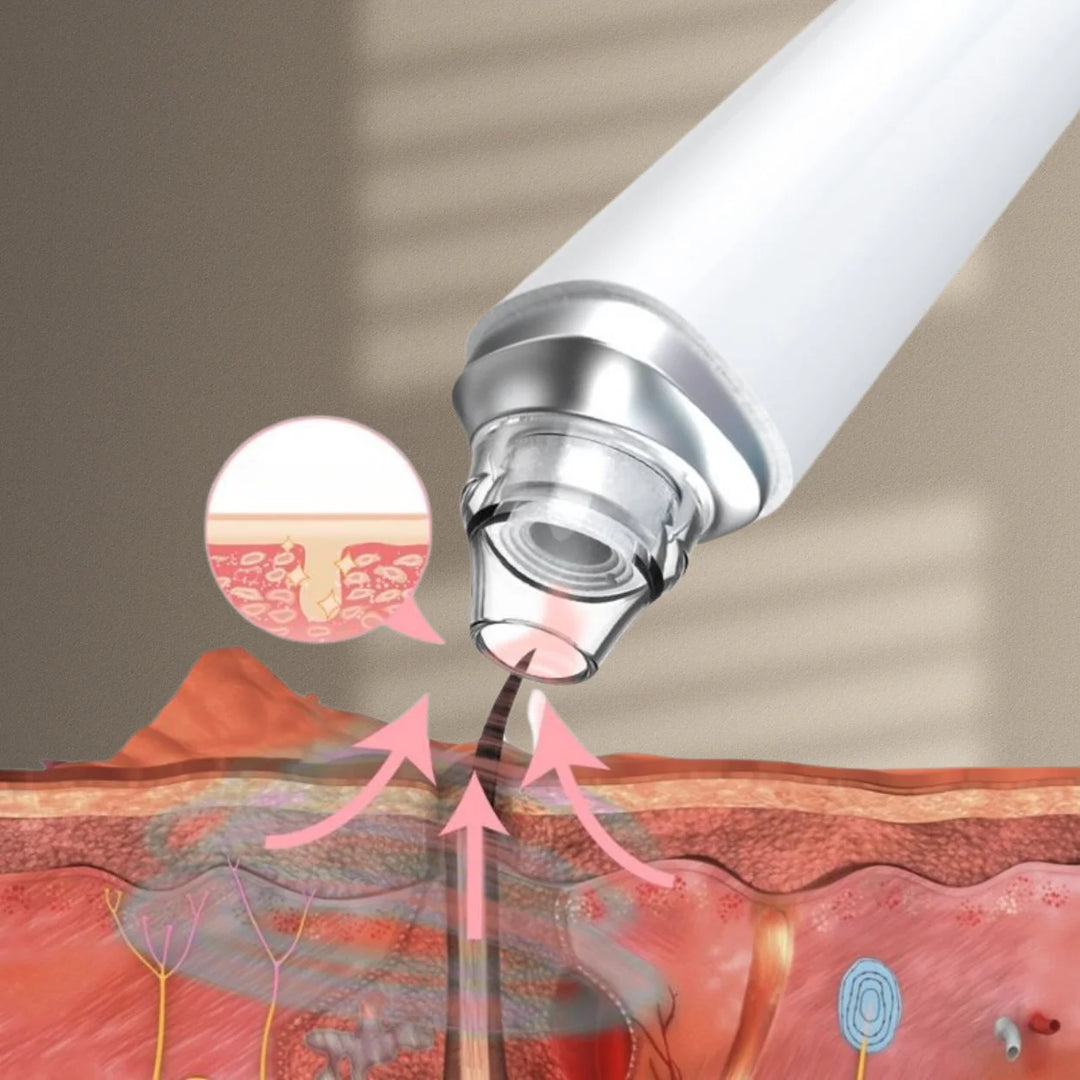 PureSight™ | Remove blackheads with precision