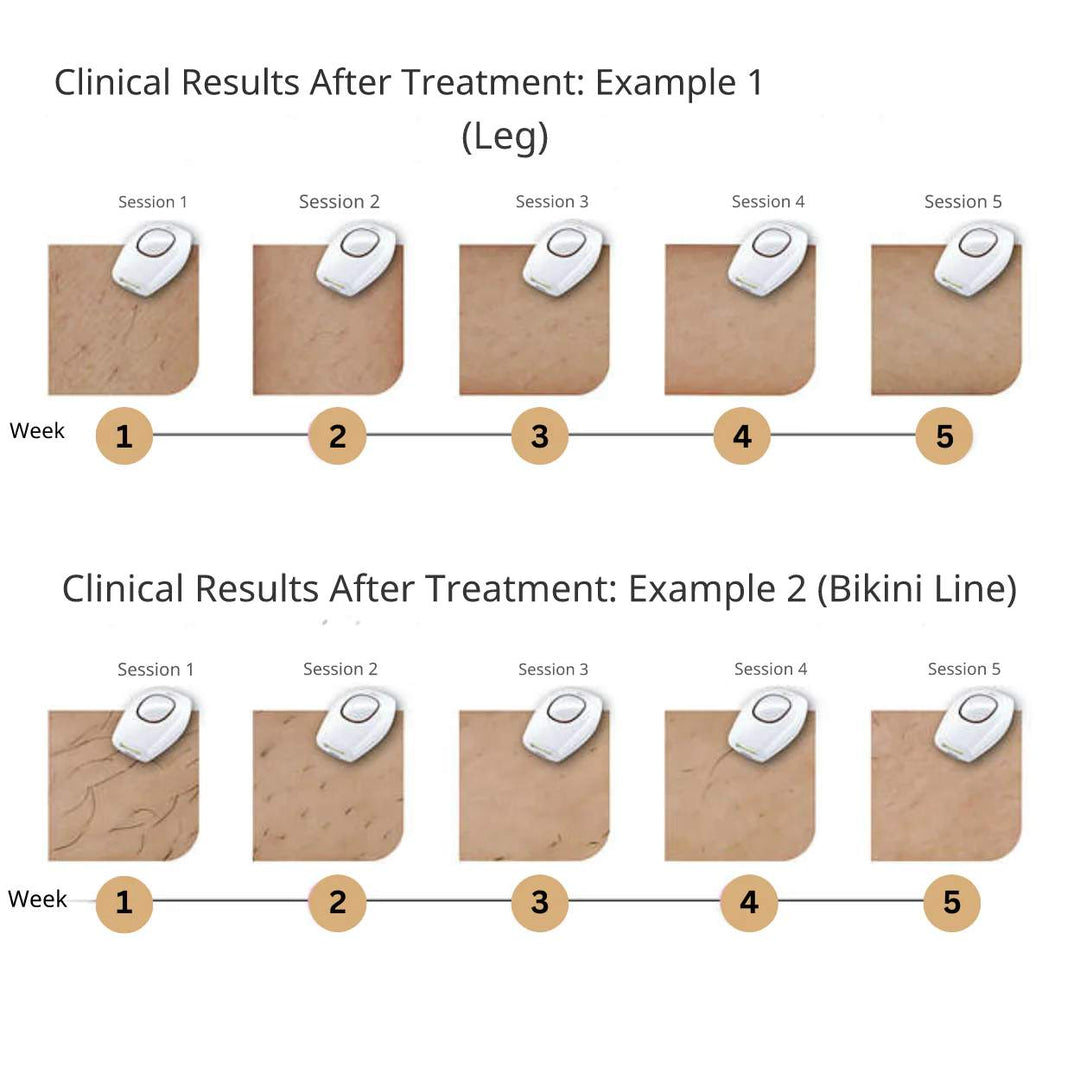 GlowFree™ | Hair-Free Skin with Ease with the IP Laser Hair Remover