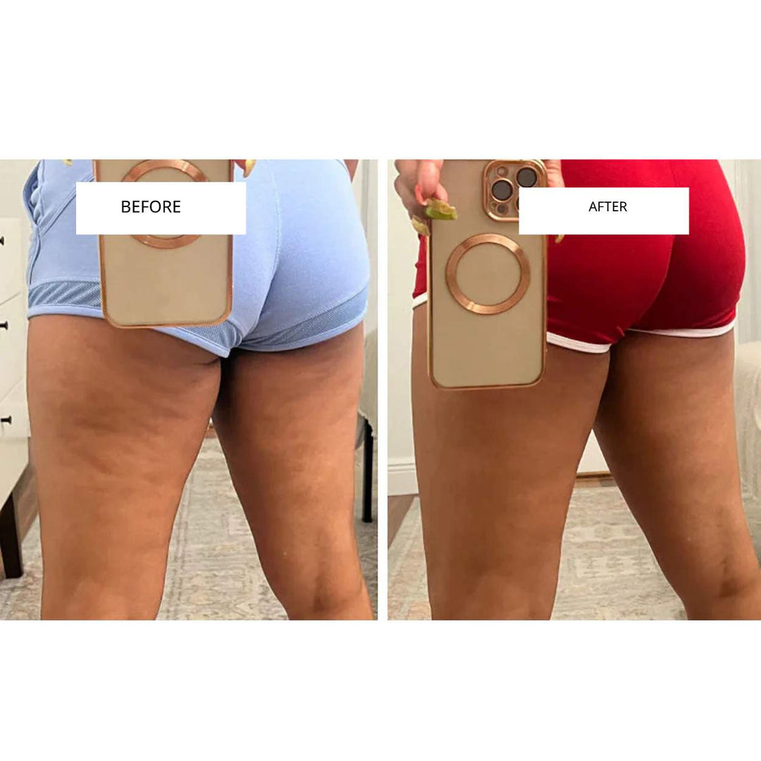 CelluLift™ | Firm your skin with the anti-cellulite vacuum massager
