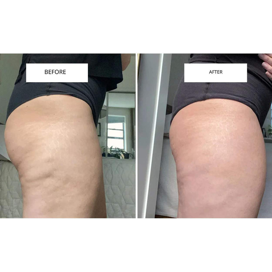 CelluLift™ | Firm your skin with the anti-cellulite vacuum massager