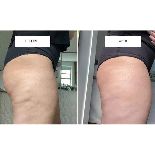 CelluLift™ | Firm your skin with the anti-cellulite vacuum massager