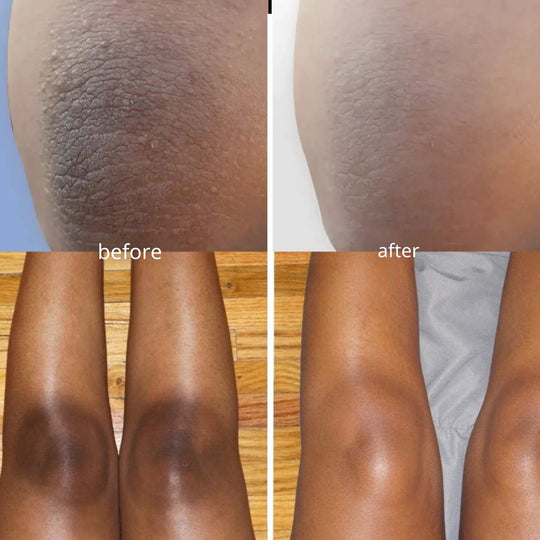 SmoothTone™ | Dark Spot Removal